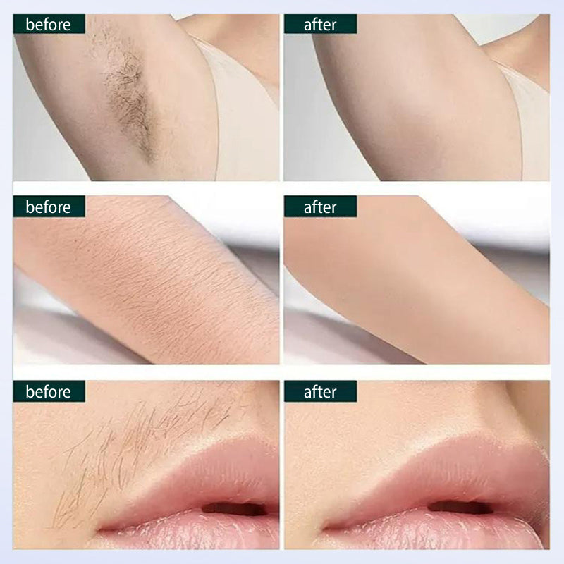 Tragbares Laser-Haarentfernungsgeräteset